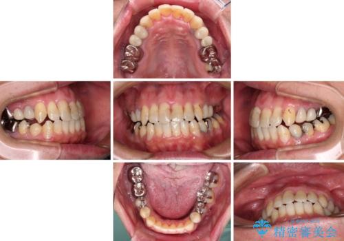 飛び出した前歯と目立つ銀歯 矯正とセラミックの総合歯科診療の治療中