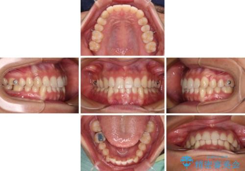 【モニター】下顎の気になる八重歯を改善 インビザラインによる矯正治療の治療中