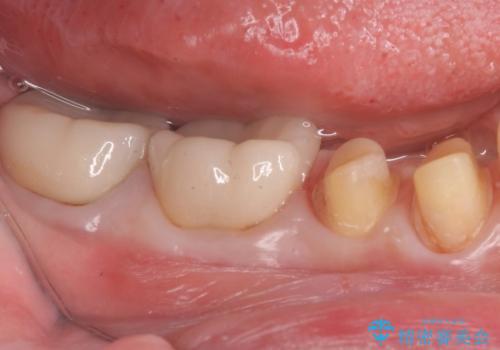 樹脂で継ぎ接ぎになった歯 セラミッククラウンでの治療の治療中