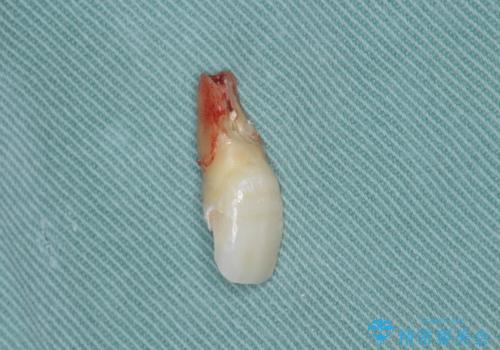 吸収し喪失した前歯、ブリッジによる審美性の回復の治療中