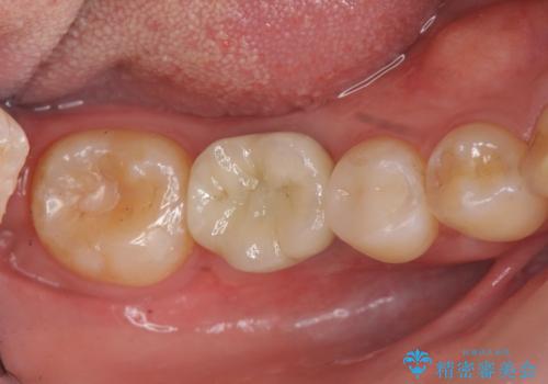 保存不可能な虫歯、インプラントによる機能回復の治療後