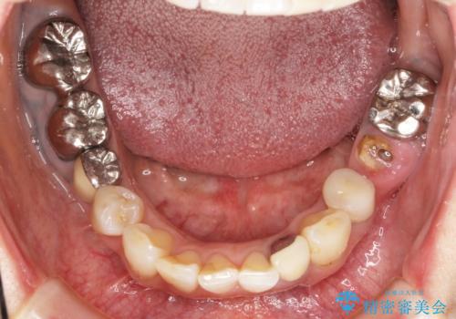 全顎的 虫歯治療 インプラント補綴の治療前