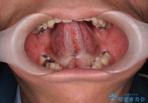 [ 舌小帯形成術 ]  滑舌を良くしたいの治療中