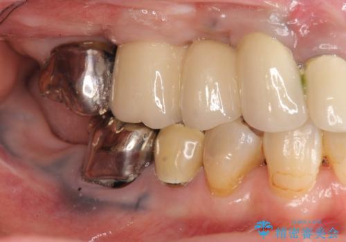 全顎的 虫歯治療 インプラント補綴の治療中