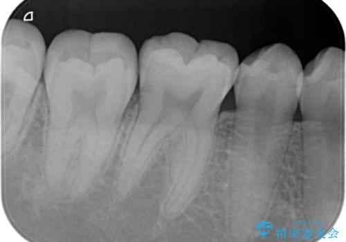 定期検診に来たら虫歯があった。の治療前