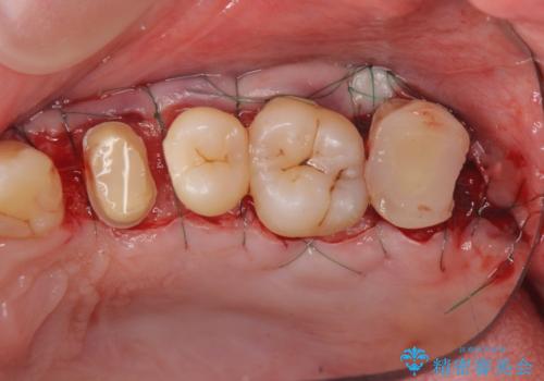 [ 歯肉縁下カリエス ]    歯周外科を行い、歯を残すの治療中