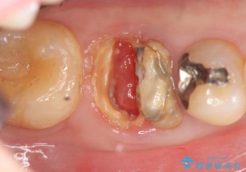 保存不可能な虫歯、インプラントによる機能回復の治療前