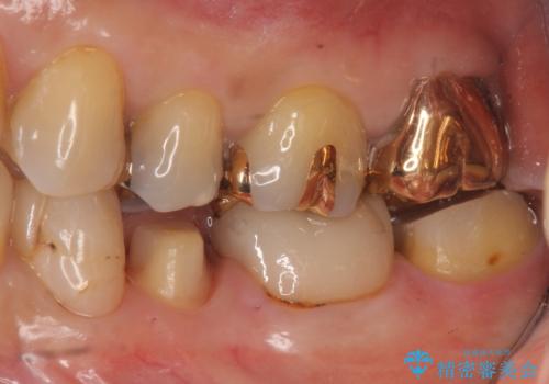 昔いれたクラウンが割れたので金属の被せ物を入れたいの治療中
