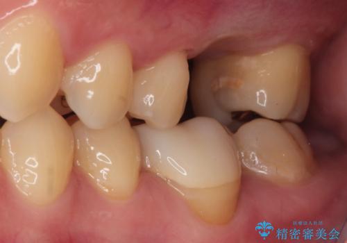 【歯牙移植】親知らずを移植して、インプラントを回避。の治療後