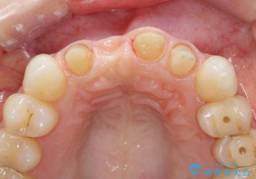 吸収し喪失した前歯、ブリッジによる審美性の回復の治療中