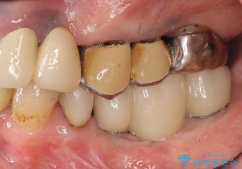 全顎的 虫歯治療 インプラント補綴の治療中