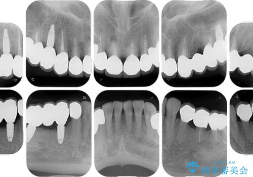 以前治療した歯がボロボロに　全顎補綴治療の治療後