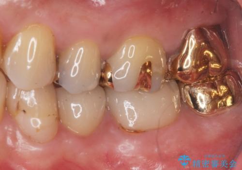 昔いれたクラウンが割れたので金属の被せ物を入れたいの治療後