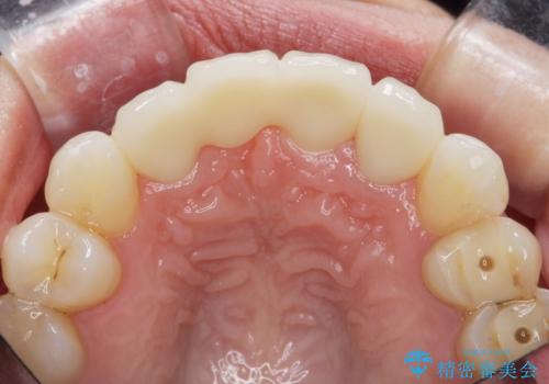 吸収し喪失した前歯、ブリッジによる審美性の回復の治療後