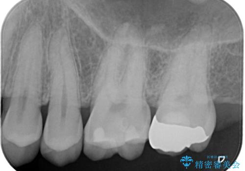 【セラミックインレー】歯科検診にて虫歯発見。の治療前
