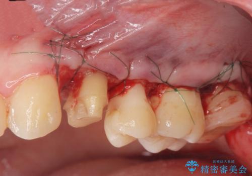 [ 歯肉縁下カリエス ]    歯周外科を行い、歯を残すの治療前
