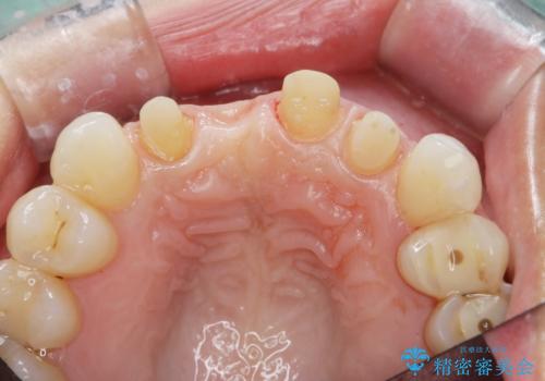 吸収し喪失した前歯、ブリッジによる審美性の回復の治療中