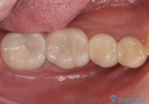 樹脂で継ぎ接ぎになった歯 セラミッククラウンでの治療の治療後