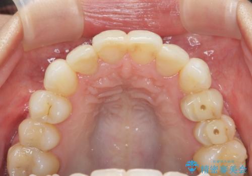吸収し喪失した前歯、ブリッジによる審美性の回復の治療前