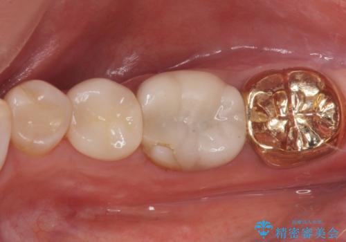 昔いれたクラウンが割れたので金属の被せ物を入れたいの治療後