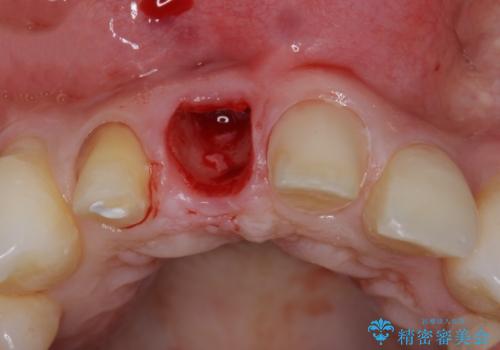 吸収し喪失した前歯、ブリッジによる審美性の回復の治療前