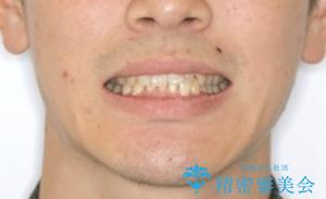 内側に入っていた前歯とガタつきをインビザラインで綺麗に並べるの治療前（顔貌）