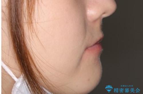 コロナ禍で矯正治療が中断:インビザラインで最終仕上げの治療前(顔貌)