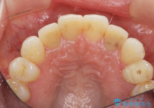 吸収し喪失した前歯、ブリッジによる審美性の回復の治療前