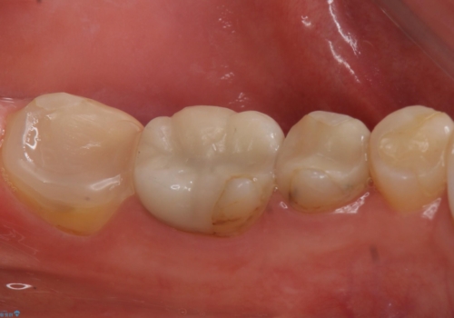 昔いれたクラウンが割れたので金属の被せ物を入れたいの治療前