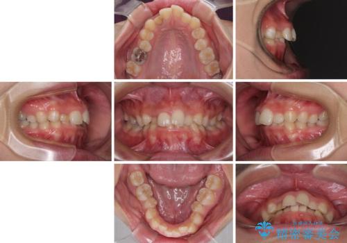 【モニター】前歯のデコボコと変色した前歯をインビザラインとオールセラミッククラウンでの治療前