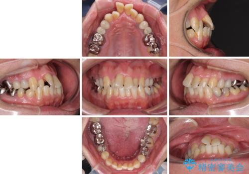飛び出した前歯と目立つ銀歯 矯正とセラミックの総合歯科診療の治療前