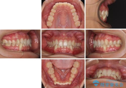 【モニター】下顎の気になる八重歯を改善 インビザラインによる矯正治療の治療前