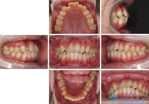 前歯のクロスバイトを改善 インビザラインによる矯正治療の治療前