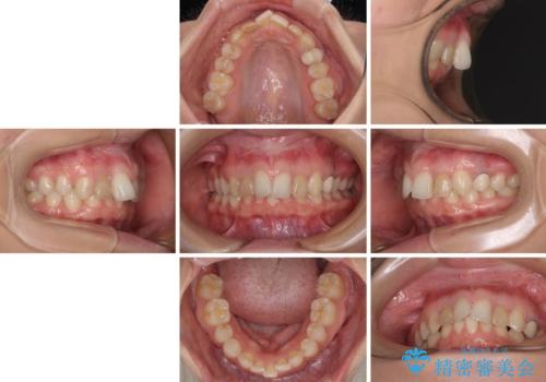 【モニター】前歯の変色とデコボコを改善　インビザラインとオールセラミックの治療前
