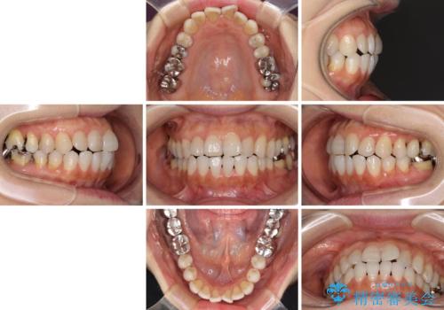 前歯の突出感と上下の隙間　インビザラインによる矯正治療の治療前