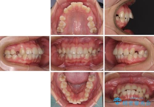 【モニター】治療途中で引っ越し　ワイヤー装置を用いた抜歯矯正の治療前