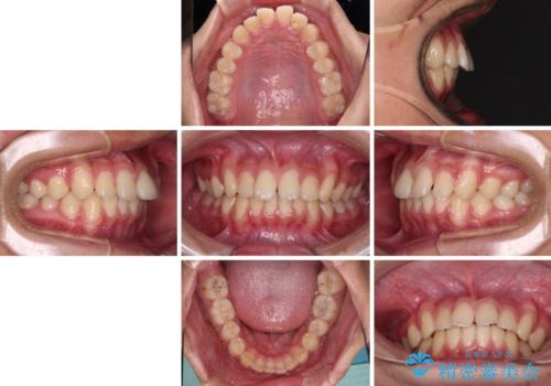 前歯の隙間とデコボコを改善 高校生のインビザライン治療の治療前
