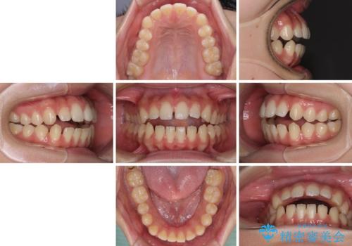 【モニター】隙間だらけの前歯を治したい インビザラインによる矯正治療の治療前