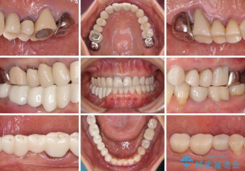 以前治療した歯がボロボロに 全顎補綴治療の治療前