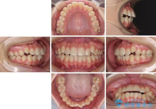 カリエール・ディスタライザーとインビザラインを用いた八重歯の改善の治療前