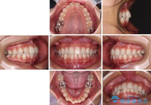 歯をきれいにしたい ワイヤー矯正治療と虫歯治療の治療前