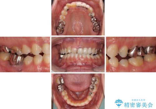 歯が全く咬みあわない　矯正と補綴の全顎治療の治療前