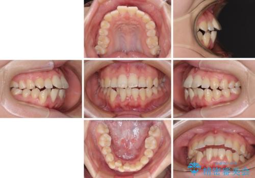 上下非接触で突出した前歯 ワイヤー装置による抜歯矯正の治療前