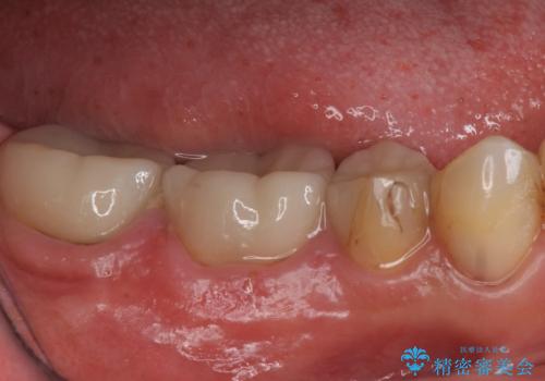 樹脂で継ぎ接ぎになった歯 セラミッククラウンでの治療の治療前