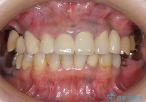 全顎的 虫歯治療 インプラント補綴の症例 治療前