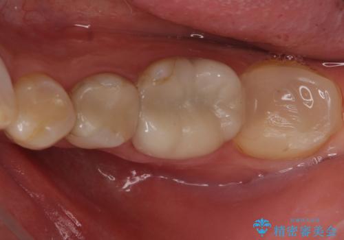 昔いれたクラウンが割れたので金属の被せ物を入れたい