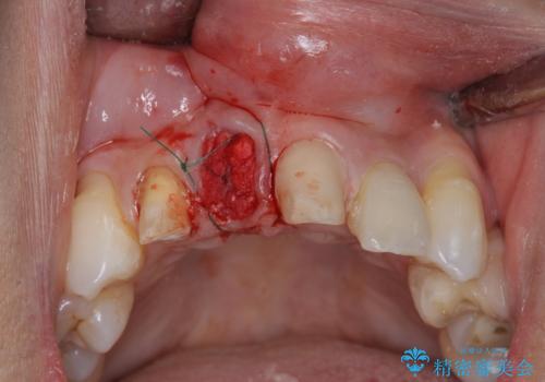 吸収し喪失した前歯、ブリッジによる審美性の回復の治療前