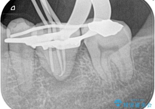 【歯牙移植】親知らずを移植して、インプラントを回避。の治療中