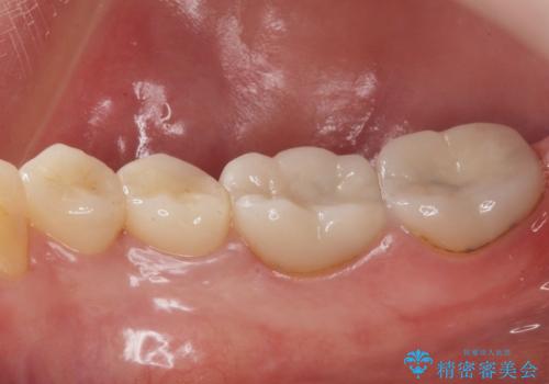 樹脂で継ぎ接ぎになった歯 セラミッククラウンでの治療の治療後