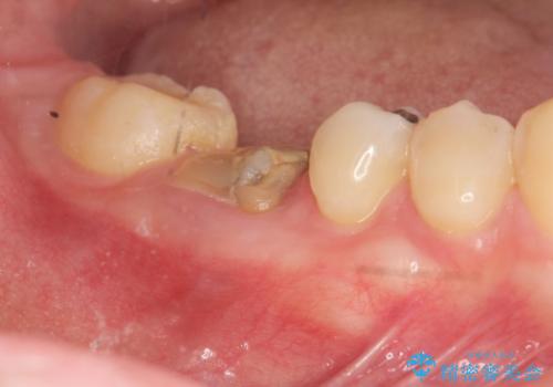 保存不可能な虫歯、インプラントによる機能回復の治療前